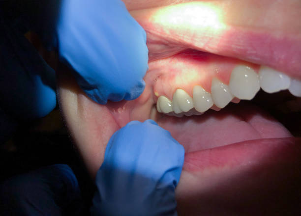Best Emergency Dental Care for Abscessed Tooth in West Hamburg, PA