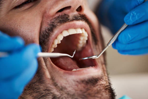 Best Emergency Dentist for Lost Fillings or Crowns in West Hamburg, PA
