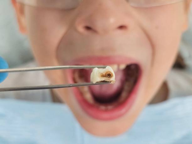 Best Emergency Dental Extractions in West Hamburg, PA
